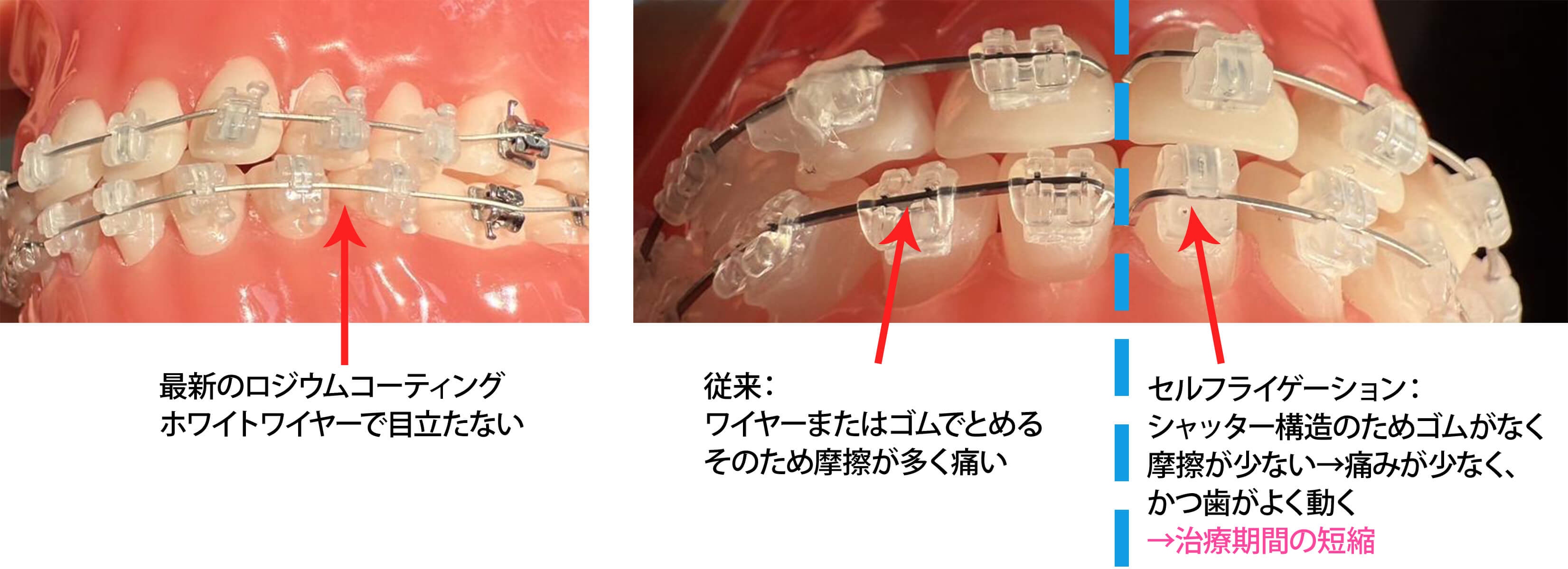 最新の矯正治療を体験しましょう