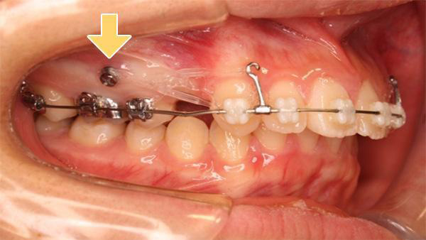 矯正用ミニインプラント